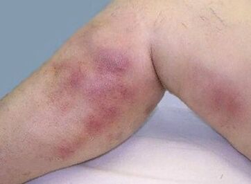 Complicacións de varices
