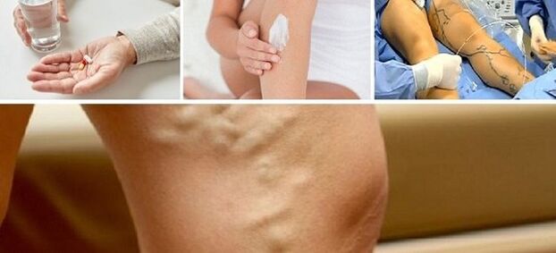 Tratamento de varices
