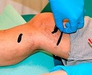 Sangrado para varices