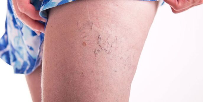 Posibilidades para tratar as varices